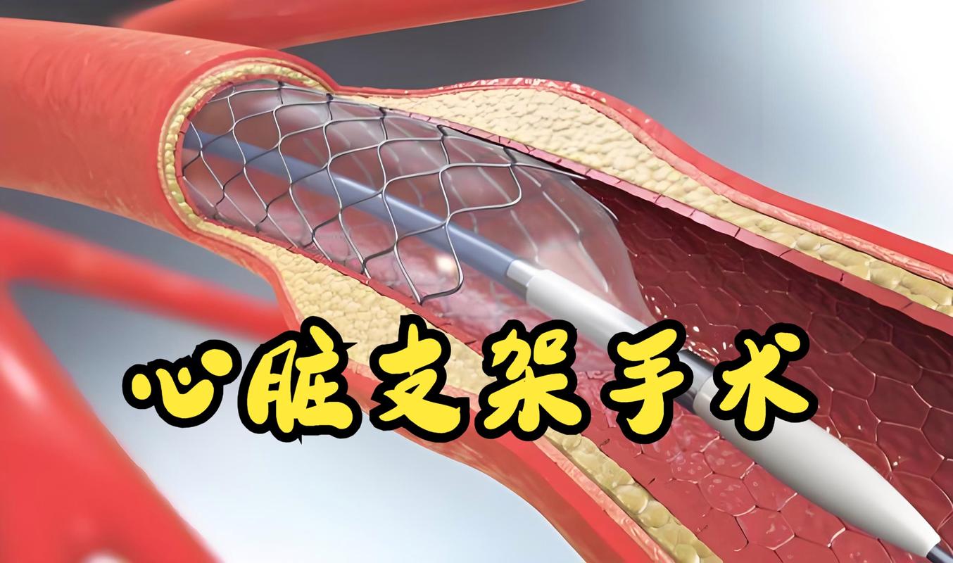 中国团队成功研发出生物可降解薄壁血管支架
