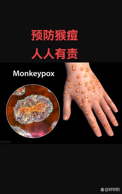 英国新增50例猴痘病例,累计确诊达574例